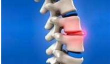 Грыжа позвоночника